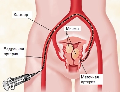 Як проводиться емболізація маткових артерій