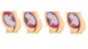 Що таке низька плацентації при вагітності