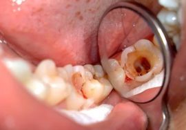 Народні засоби від зубного болю