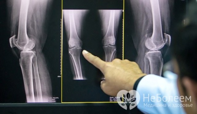Остеоартроз колінного суглоба 1 ступеня: лікування