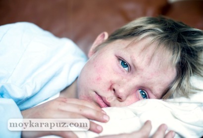Цитомегаловірусна інфекція у дітей і жінок