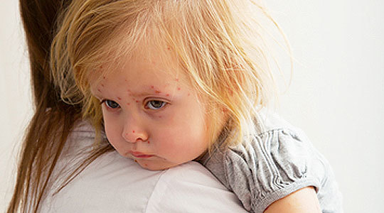 Корь у детей: симптомы, лечение, профилактика