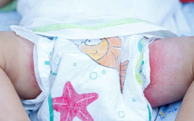 Попрілості у новонароджених: чим лікувати?