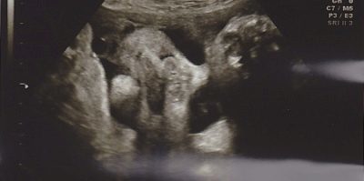 Що відбувається з малюком на 35 тижнів вагітності: фото і подробиці
