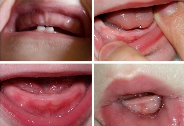 Симптоми прорізування зубів у немовлят