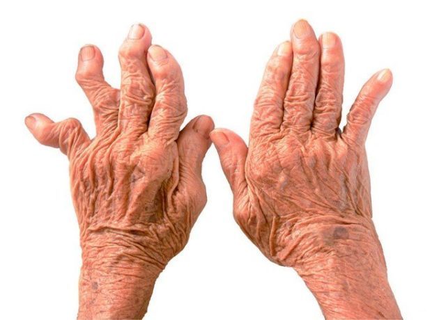 Артроз пальців рук, симптоми і лікування