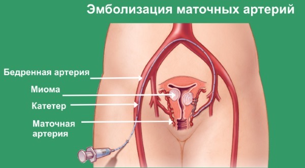 Как проводится эмболизация маточных артерий