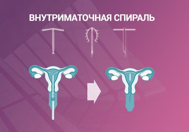 Варіанти екстреної контрацепції до і після статевого акту