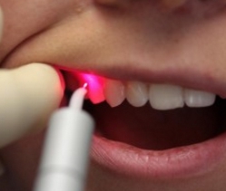 Возможно ли лечение кисты зуба без удаления
