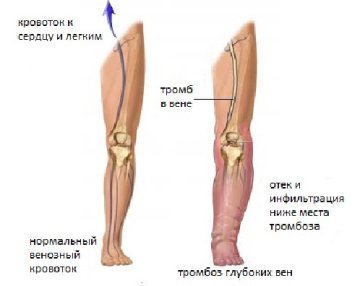 Тромбофлебіт глибоких вен нижніх кінцівок: симптоми, лікування