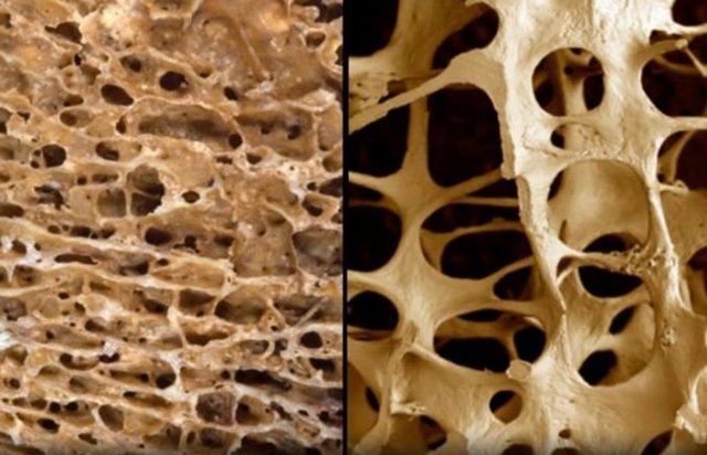 Огляд препаратів з кальцієм для профілактики остеопорозу