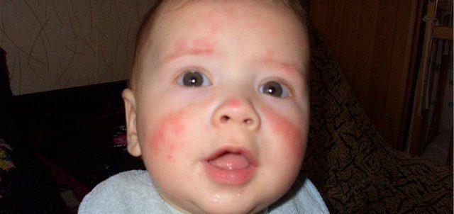 Особливості алергії на обличчі, причини, методи лікування, алергія на обличчі у дітей