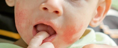Себорейний дерматит у дітей: причини, симптоми, лікування