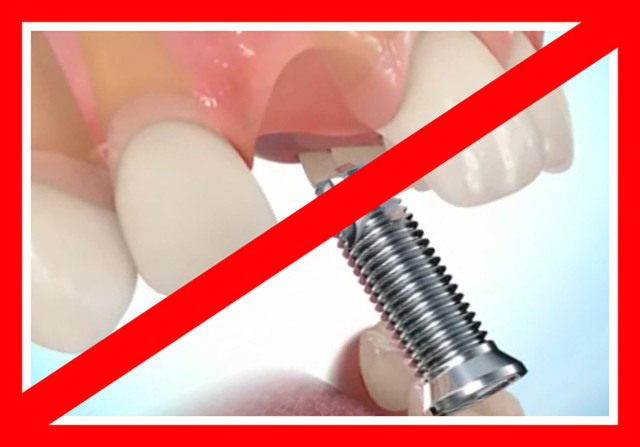 Імплантація зубів: протипоказання і можливі ускладнення