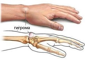 Гігрома зап'ястя лікування без операції