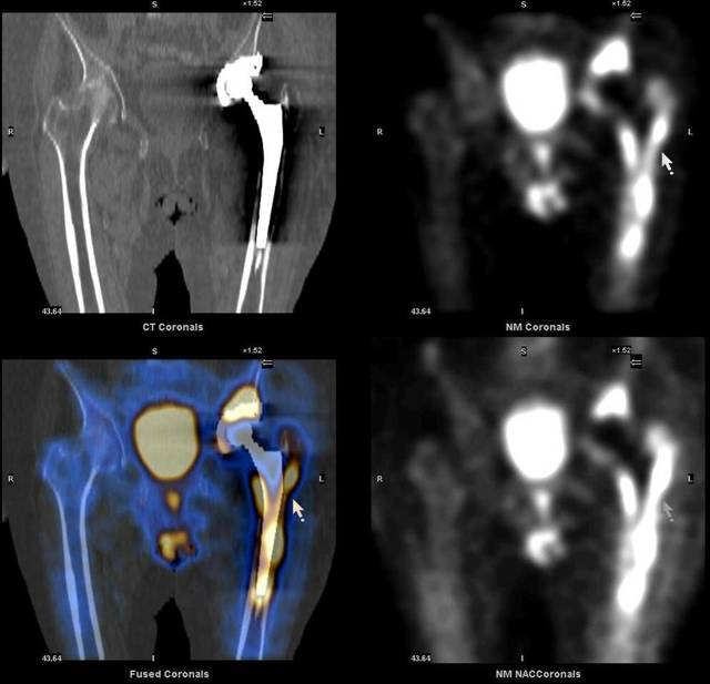 Сцинтиграфія кісток скелета: прогресивний метод діагностики