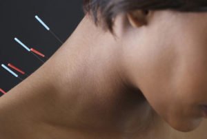 Як може допомогти голковколювання при остеохондрозі шийного відділу хребта
