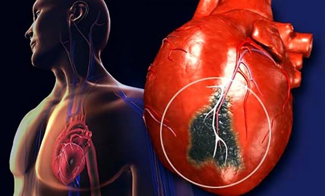 Інфаркт у чоловіків і жінок: симптоми і перші ознаки