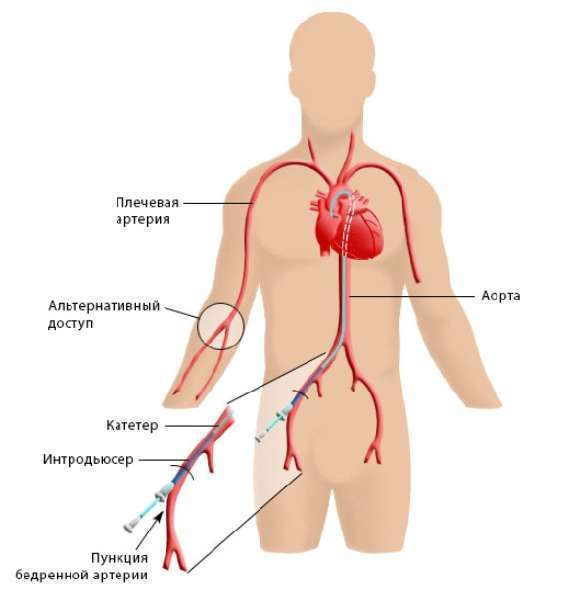 Ішемічна хвороба і стентування судин серця