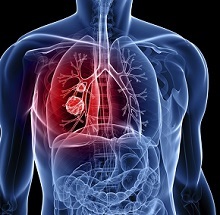 Рак легенів: симптоми і ознаки