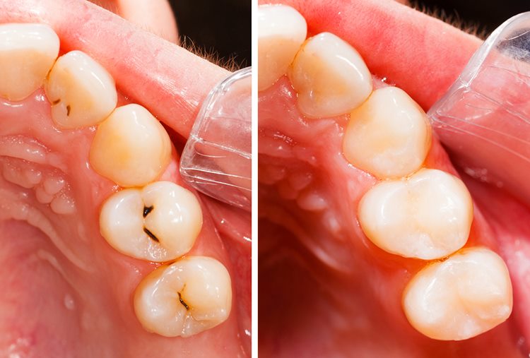 Яку пломбу краще ставити на жувальні зуби дорослим