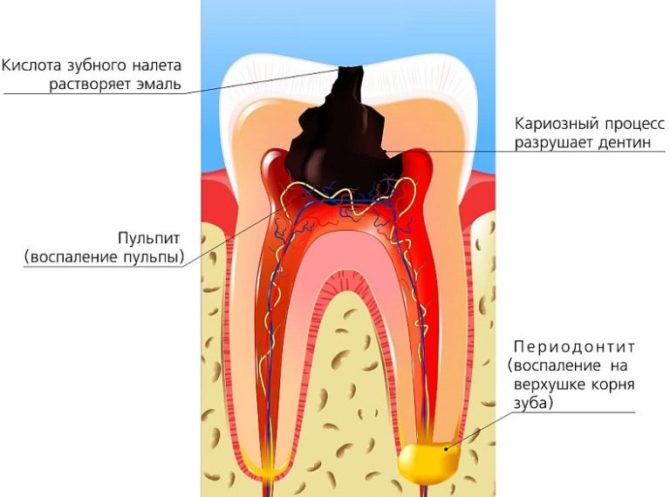 Болить зуб народні методи лікування
