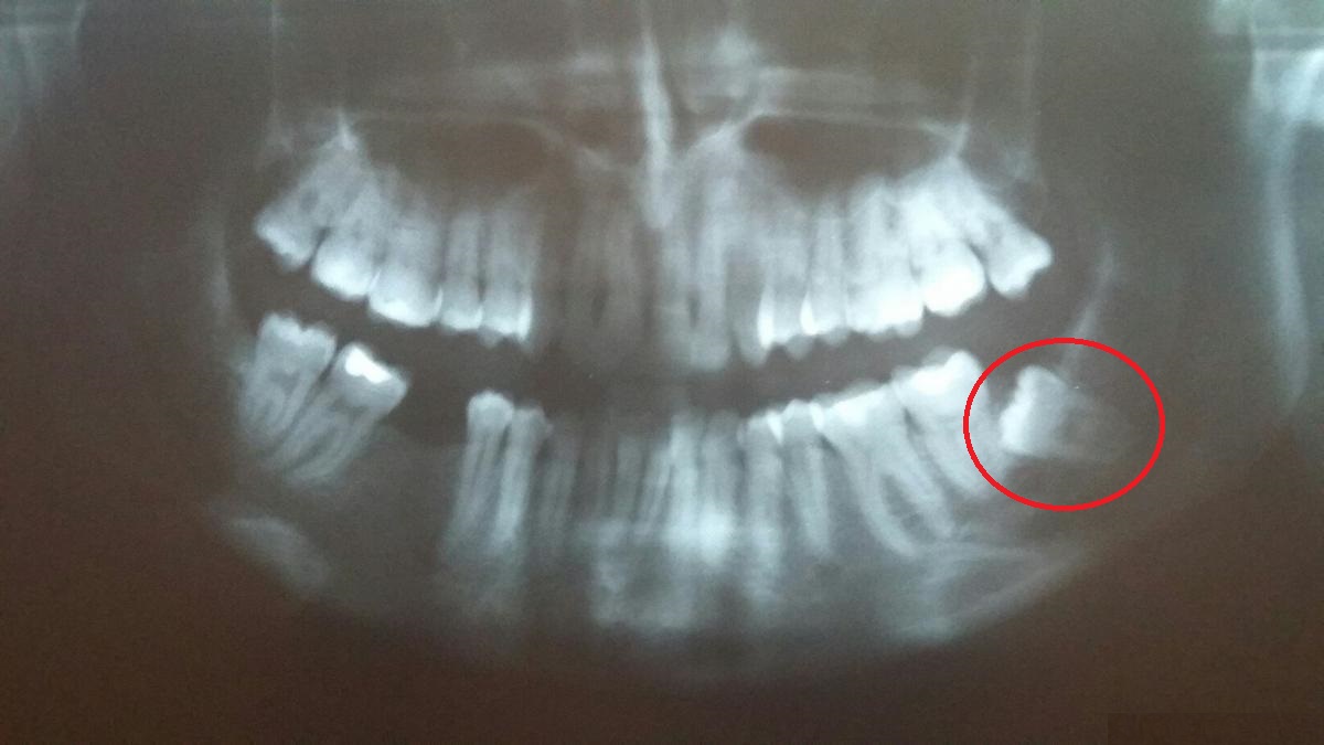 Зуб 8 корень. Ретинированный зуб мудрости рентген. Кривой зуб мудрости рентген. Горизонтально ретинированный зуб мудрости.