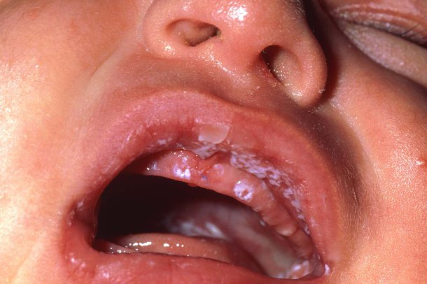 Бактеріальний стоматит симптоми і лікування у дітей