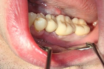 Яку пломбу краще ставити на жувальні зуби дорослим