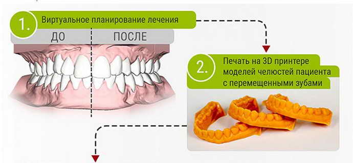 Чи допомагає капа для вирівнювання зубів у дітей