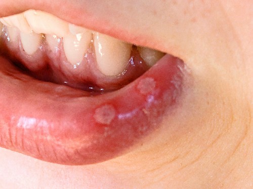 Бактеріальний стоматит симптоми і лікування у дітей