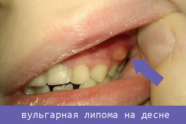 Білі шишечки в роті у дитини